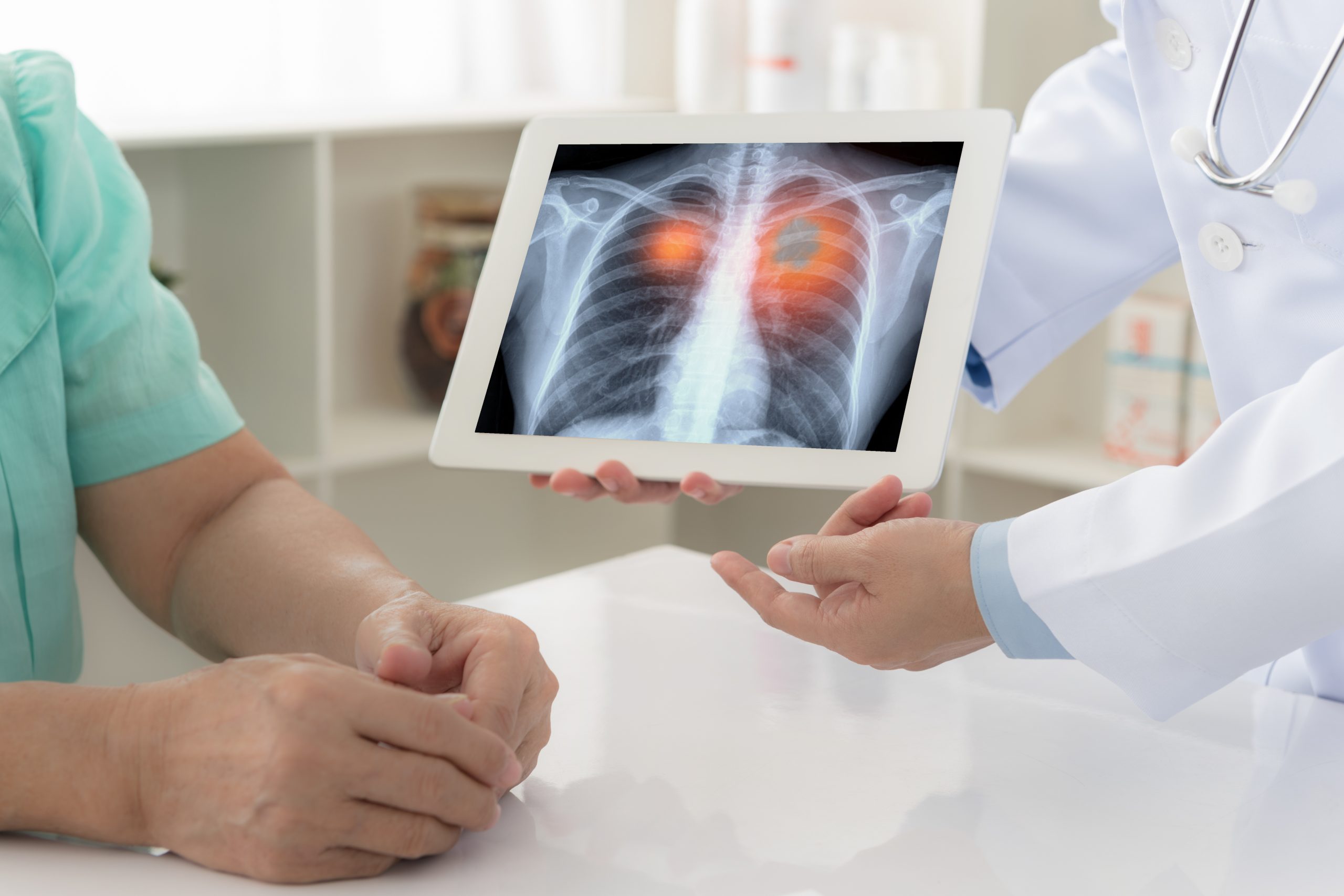 Personalised Treatment to Fight Lung Cancer