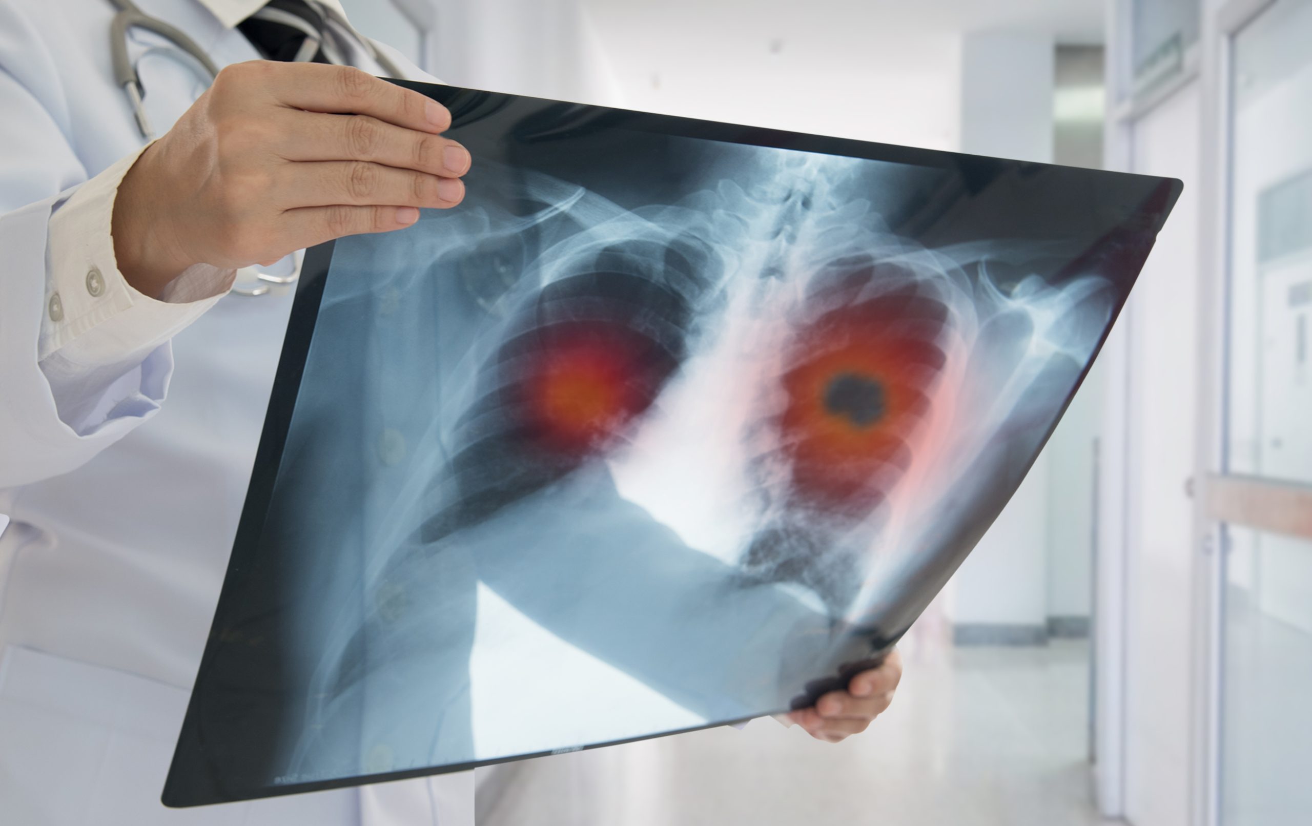 Understanding Lung Cancer: Causes, Symptoms, and Treatment